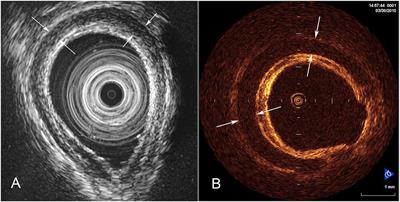 Imaging of Airway Obstruction in Children